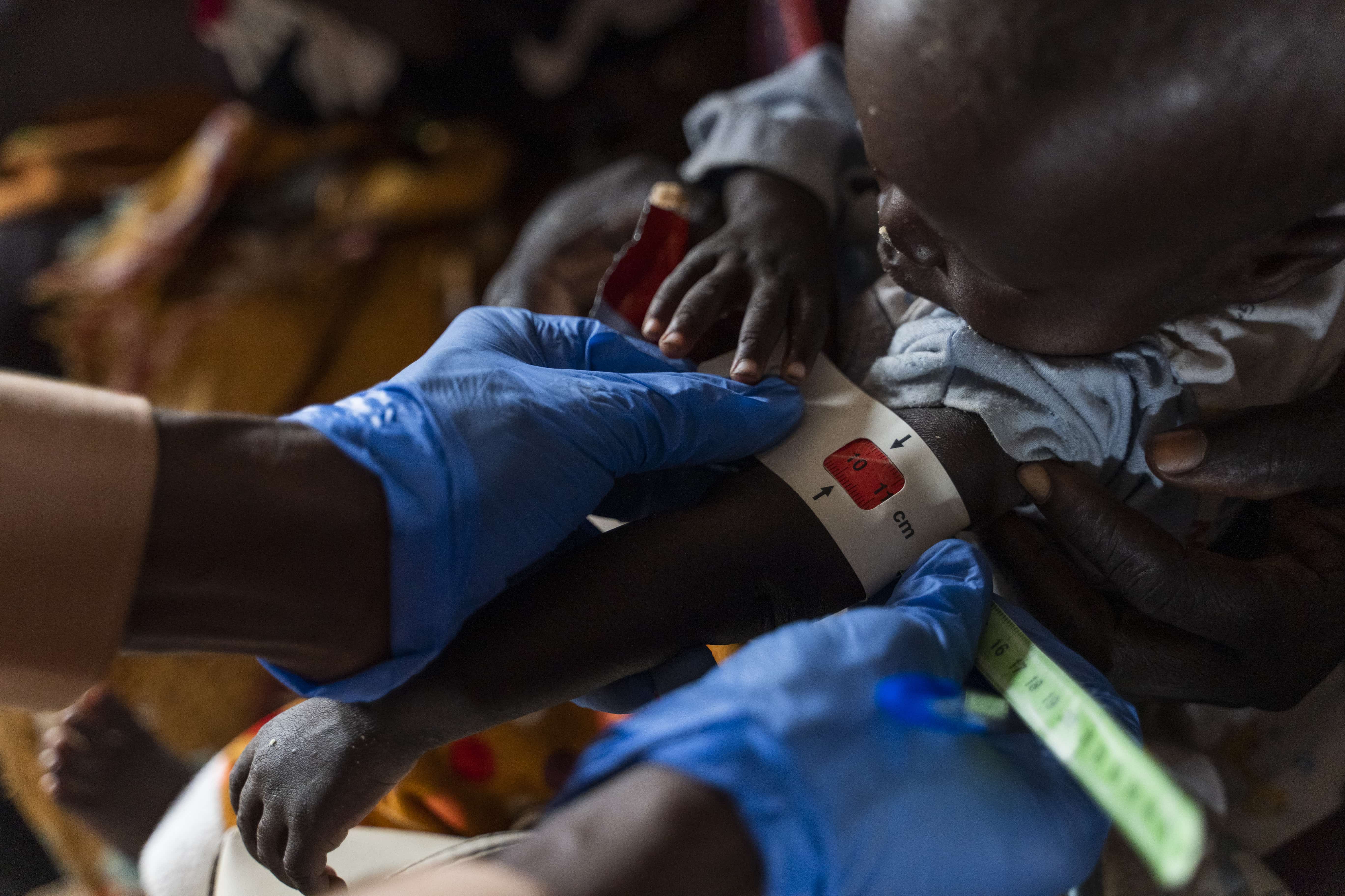 A child is assessed for malnutrition in a displacement camp in White Nile State, Sudan.